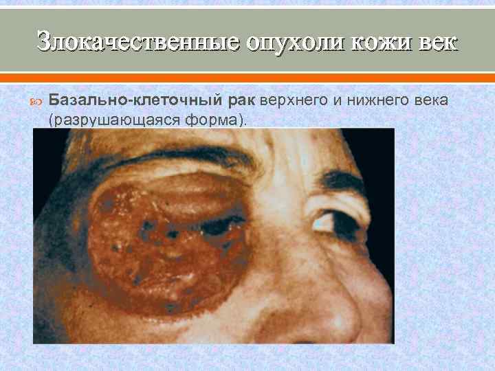 Злокачественные опухоли кожи век Базально-клеточный рак верхнего и нижнего века (разрушающаяся форма). 