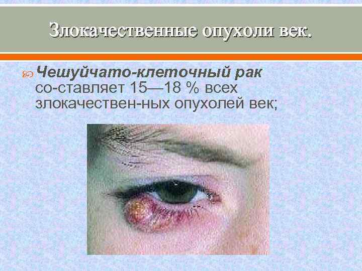 Злокачественные опухоли век. Чешуйчато-клеточный рак со ставляет 15— 18 % всех злокачествен ных опухолей