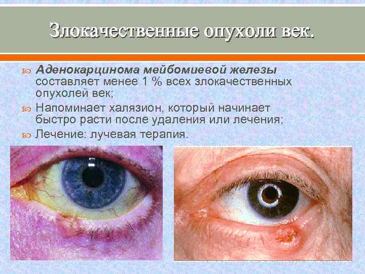 Злокачественные опухоли век. Аденокарцинома мейбомиевой железы составляет менее 1 % всех злокачественных опухолей век;