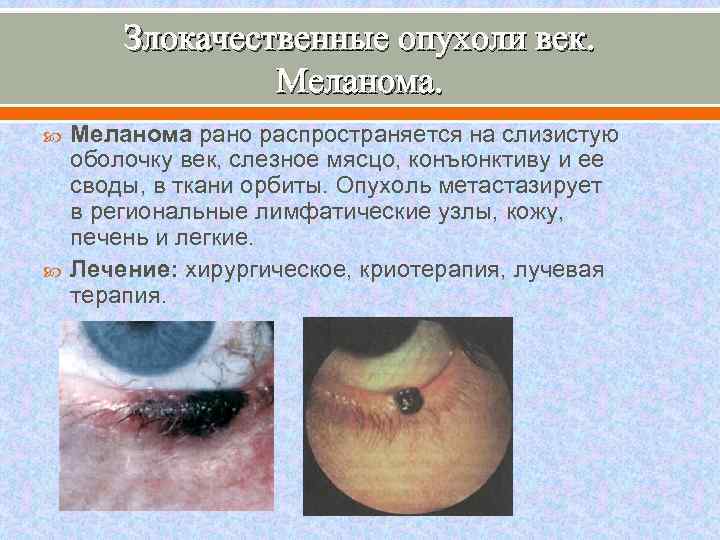 Злокачественные опухоли век. Меланома рано распространяется на слизистую оболочку век, слезное мясцо, конъюнктиву и