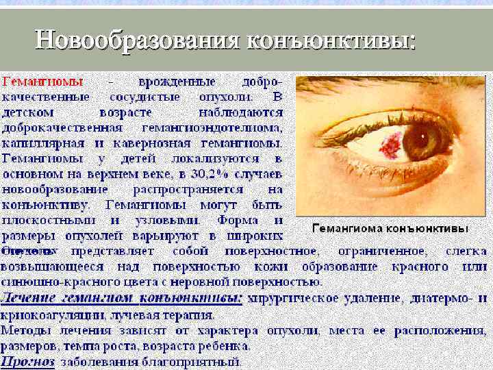 Новообразования конъюнктивы: 