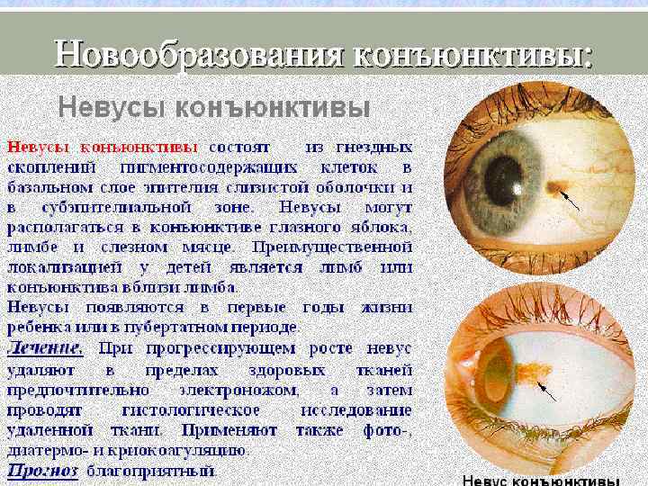 Новообразования конъюнктивы: 