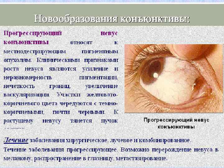 Новообразования конъюнктивы: 