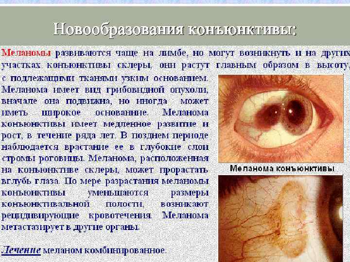 Новообразования конъюнктивы: 