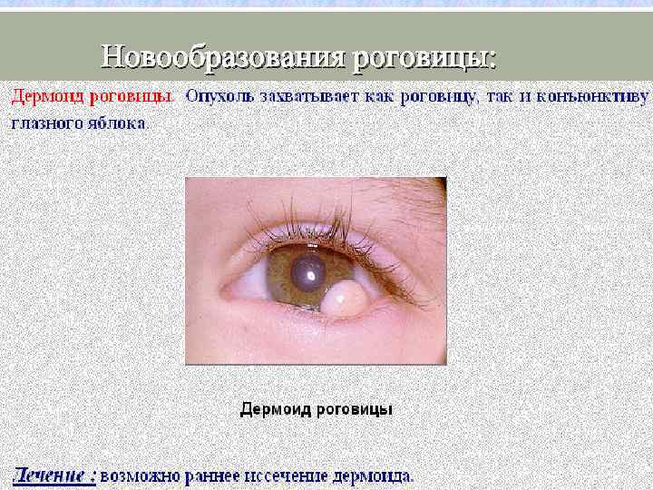 Новообразования роговицы: 