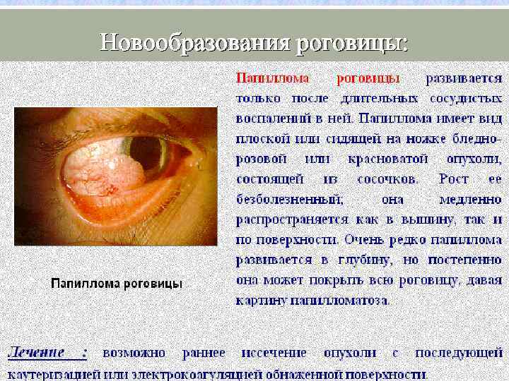 Новообразования роговицы: 