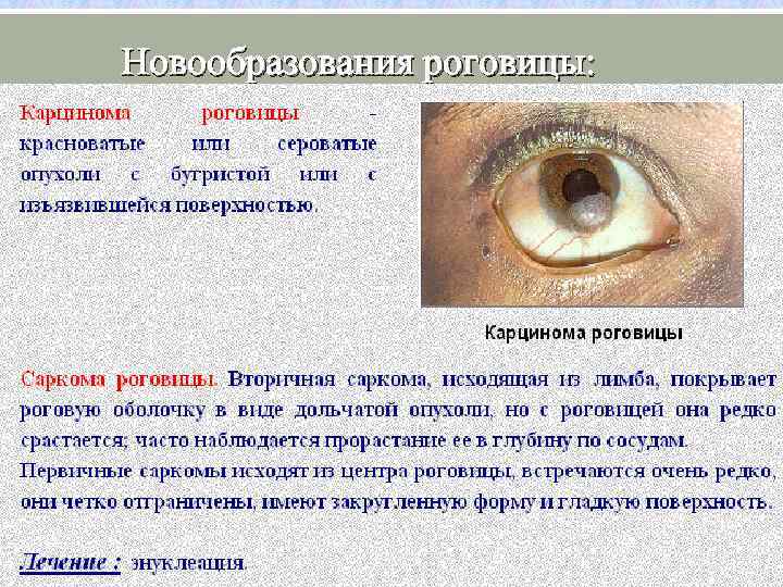 Новообразования роговицы: : 