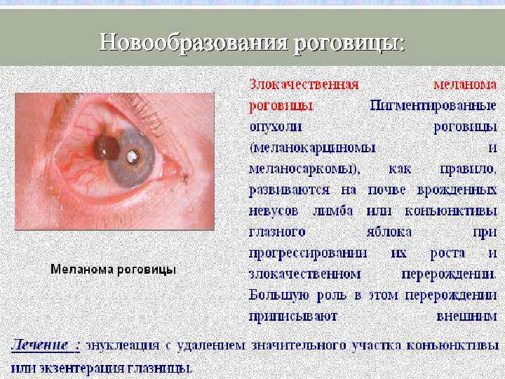 Новообразования роговицы: 