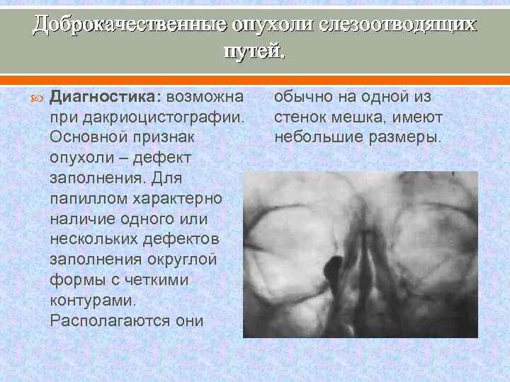 Доброкачественные опухоли слезоотводящих путей. Диагностика: возможна при дакриоцистографии. Основной признак опухоли – дефект заполнения.