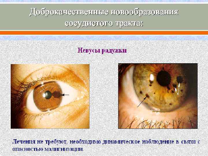 Доброкачественные новообразования сосудистого тракта: 