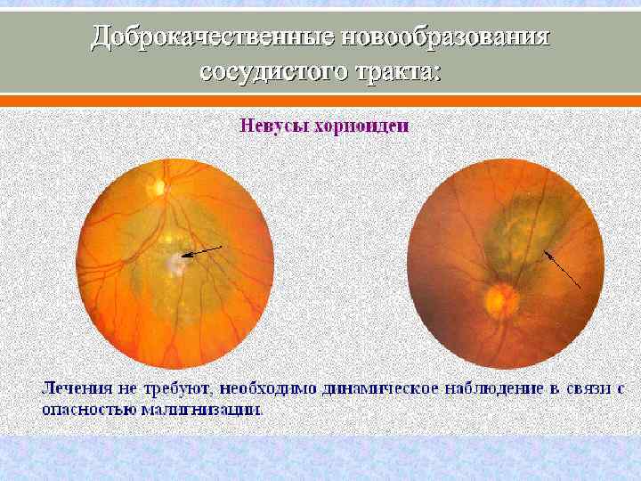 Доброкачественные новообразования сосудистого тракта: 