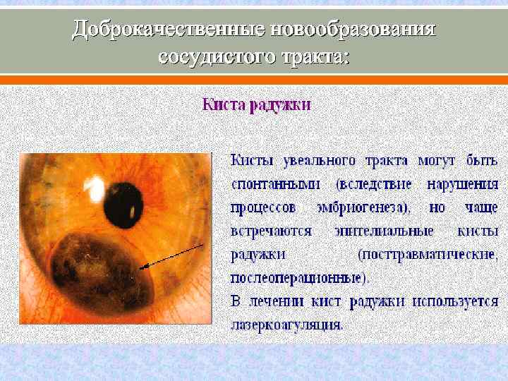 Доброкачественные новообразования сосудистого тракта: 