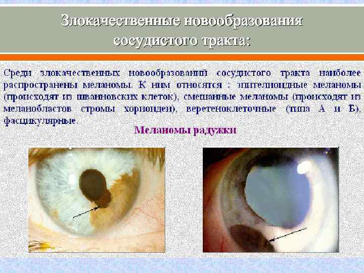 Злокачественные новообразования сосудистого тракта: 