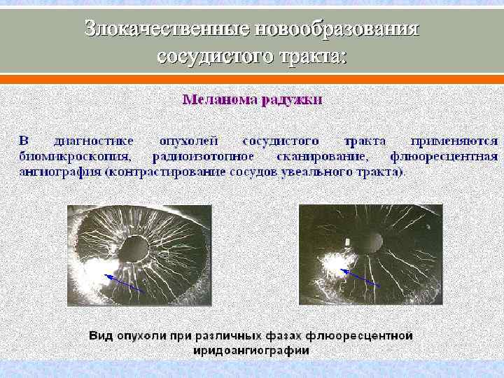 Злокачественные новообразования сосудистого тракта: 