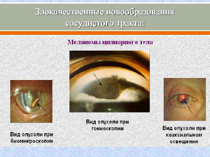 Злокачественные новообразования сосудистого тракта: 