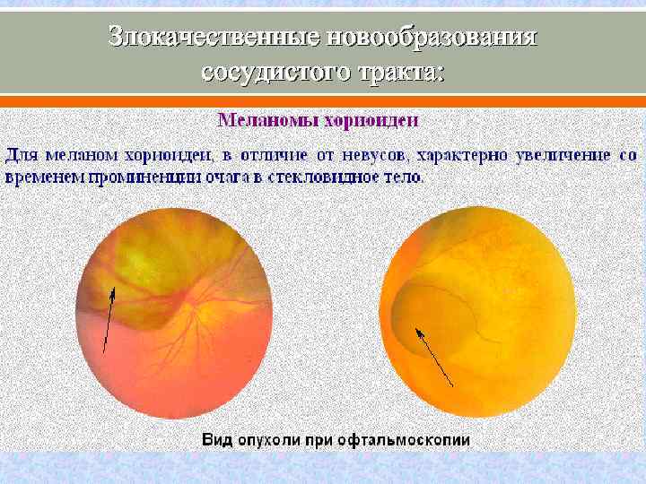 Злокачественные новообразования сосудистого тракта: 