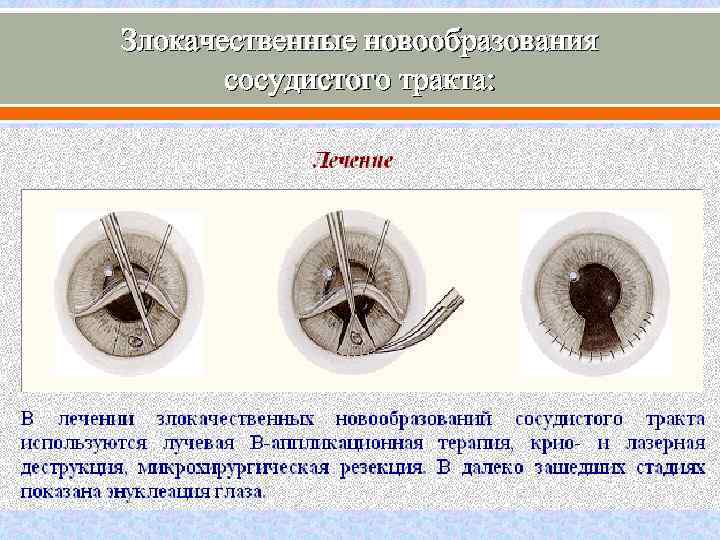 Злокачественные новообразования сосудистого тракта: 