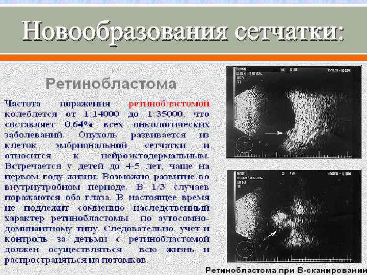 Новообразования сетчатки: 