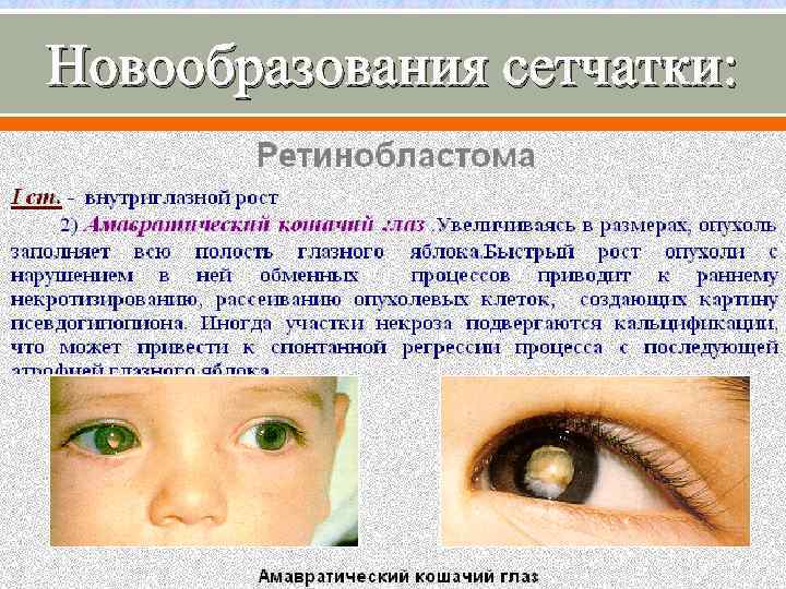 Новообразования сетчатки: 