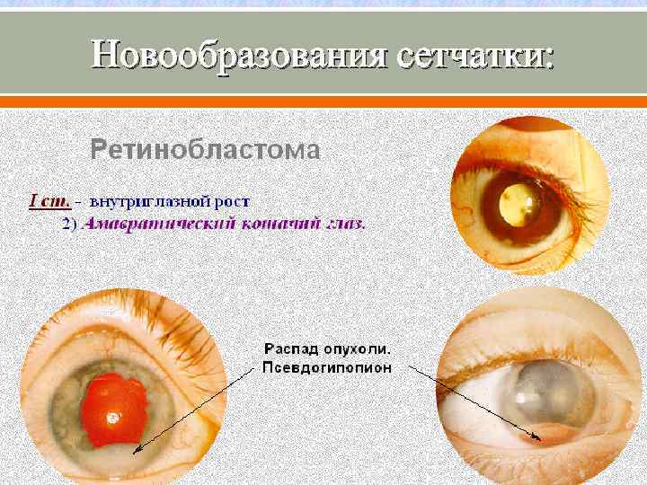 Новообразования сетчатки глаза. Новообразования сетчатки. Новообразования сетчатой оболочки. Опухоли глаза классификация.