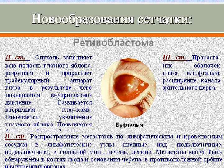 Новообразования сетчатки: 