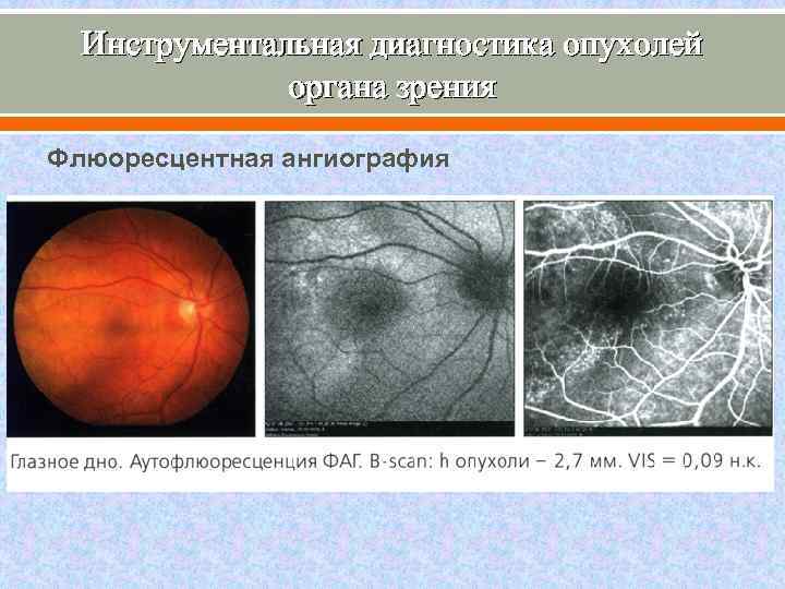 Инструментальная диагностика опухолей органа зрения Флюоресцентная ангиография 