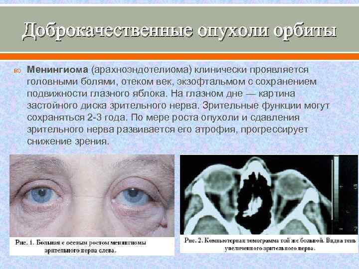 Доброкачественные опухоли орбиты Менингиома (арахноэндотелиома) клинически проявляется головными болями, отеком век, экзофтальмом с сохранением