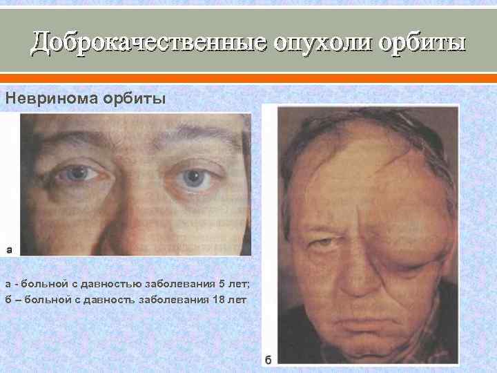 Доброкачественные опухоли орбиты Невринома орбиты а - больной с давностью заболевания 5 лет; б