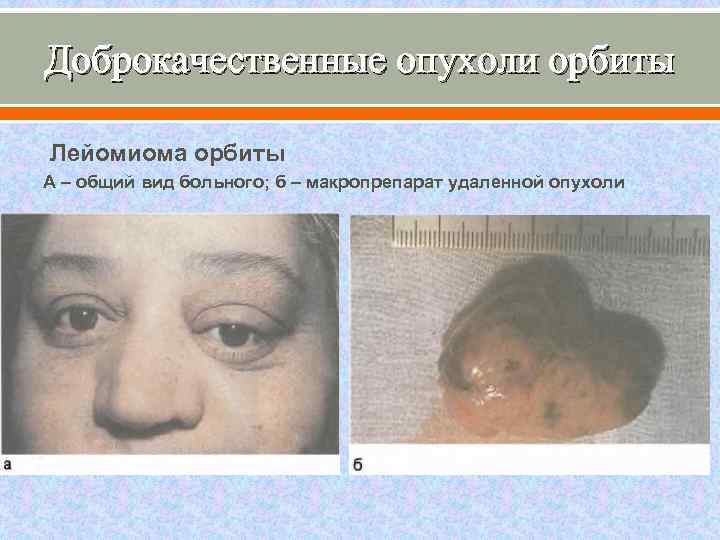Доброкачественные опухоли орбиты Лейомиома орбиты А – общий вид больного; б – макропрепарат удаленной