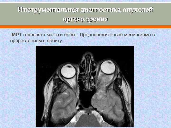 Инструментальная диагностика опухолей органа зрения МРТ головного мозга и орбит. Предположительно менингиома с прорастанием