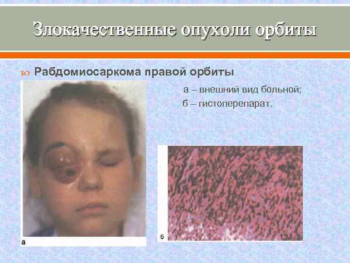 Злокачественные опухоли орбиты Рабдомиосаркома правой орбиты а – внешний вид больной; б – гистоперепарат.