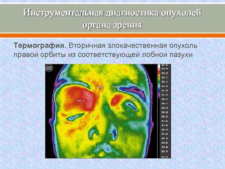 Инструментальная диагностика опухолей органа зрения Термография. Вторичная злокачественная опухоль правой орбиты из соответствующей лобной