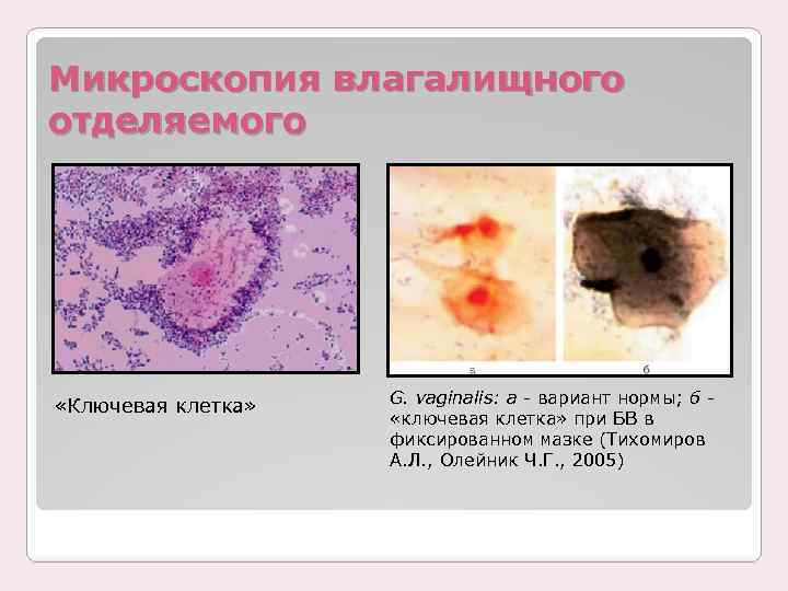 Микроскопия влагалищного отделяемого «Ключевая клетка» G. vaginalis: а - вариант нормы; б - «ключевая