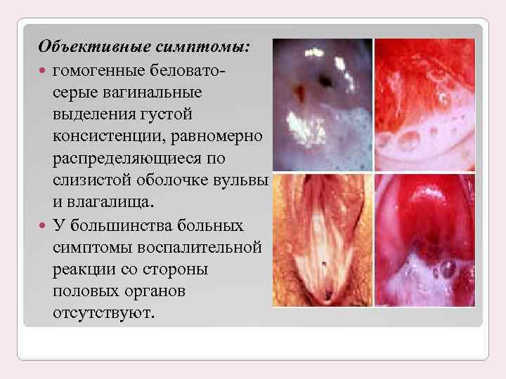 Объективные симптомы: гомогенные беловатосерые вагинальные выделения густой консистенции, равномерно распределяющиеся по слизистой оболочке вульвы