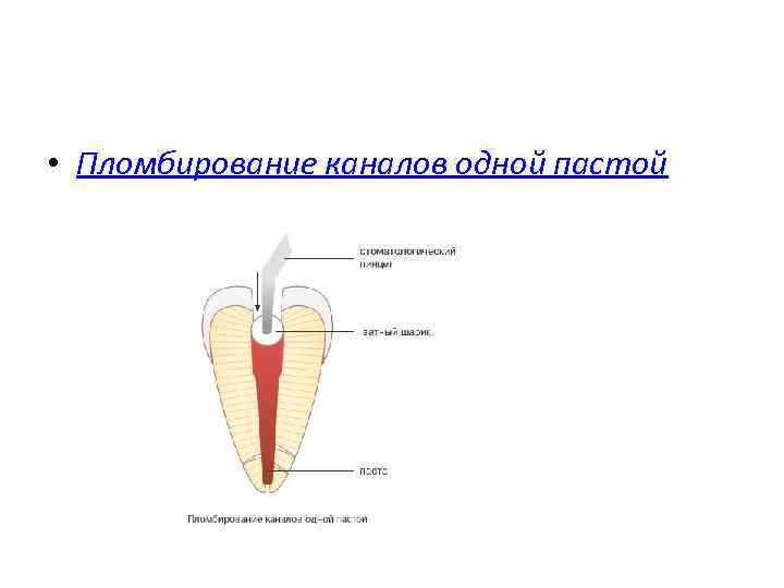  • Пломбирование каналов одной пастой 