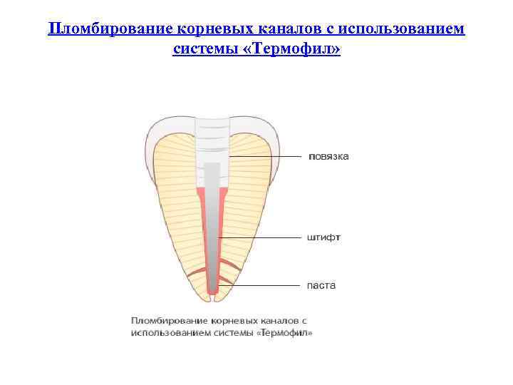 Пломбирование корневых каналов с использованием системы «Термофил» 