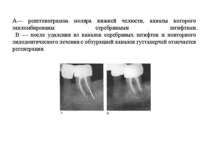  А— рентгенограмма моляра нижней челюсти, каналы которого запломбированы серебряными штифтами. В — после
