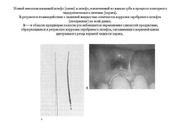  Новый неиспользованный штифт (слева) и штифт, извлеченный из канала зуба в процессе повторного