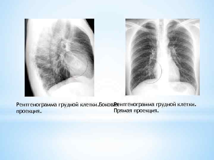 Рентгенограмма грудной клетки. Боковая Прямая проекция. 