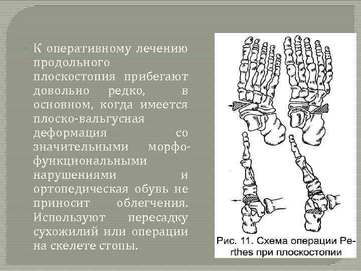  К оперативному лечению продольного плоскостопия прибегают довольно редко, в основном, когда имеется плоско-вальгусная