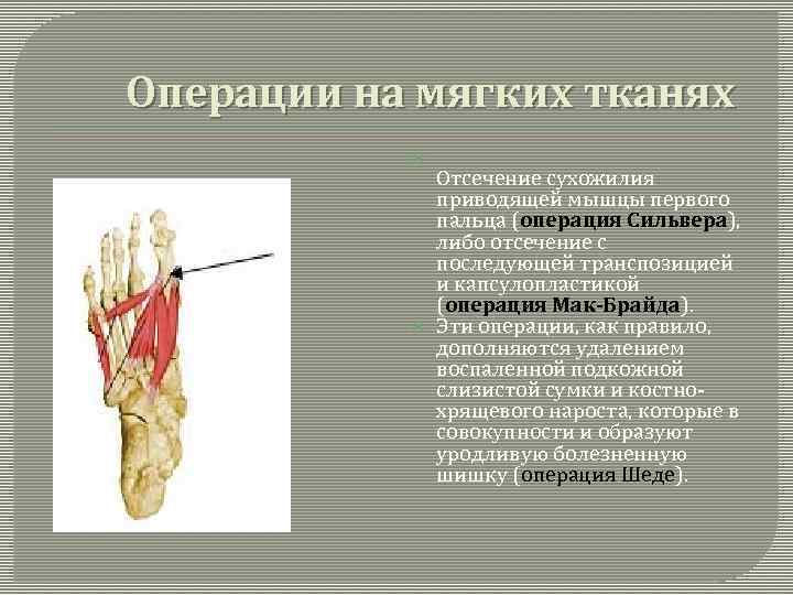 Операции на мягких тканях Отсечение сухожилия приводящей мышцы первого пальца (операция Сильвера), либо отсечение