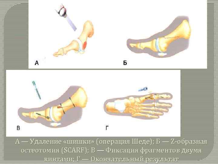 А — Удаление «шишки» (операция Шеде); Б — Z-образная остеотомия (SCARF); В — Фиксация