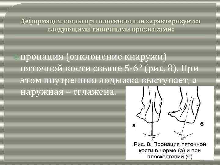 Деформация стопы при плоскостопии характеризуется следующими типичными признаками: пронация (отклонение кнаружи) пяточной кости свыше