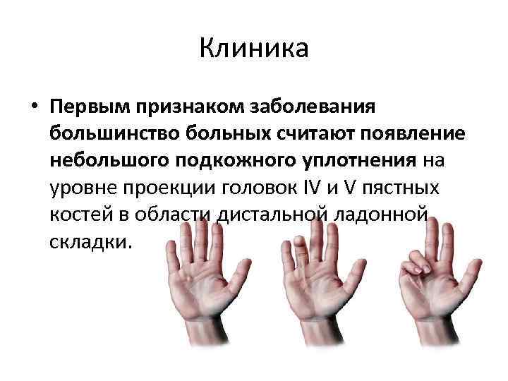 Клиника • Первым признаком заболевания большинство больных считают появление небольшого подкожного уплотнения на уровне