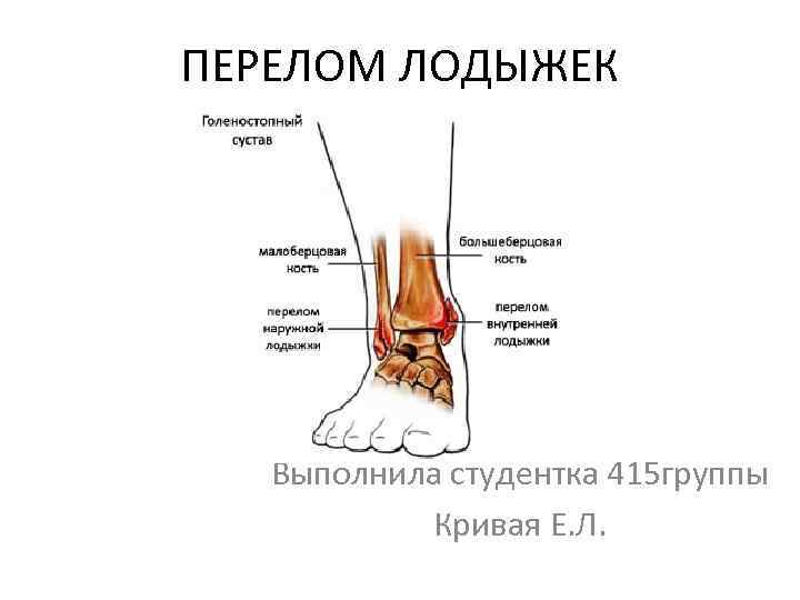 ПЕРЕЛОМ ЛОДЫЖЕК Выполнила студентка 415 группы Кривая Е. Л. 