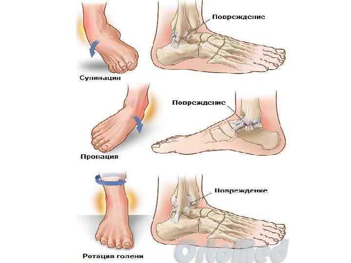 Презентация перелом лодыжек