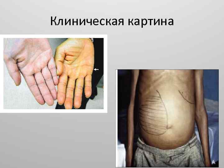 Клиническая картина 