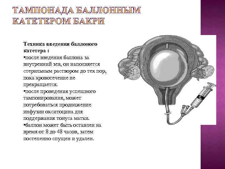 Техника введения баллоного катетера : • после введения баллона за внутренний зев, он наполняется