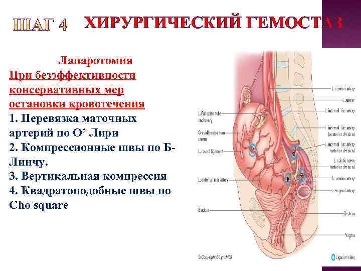 ХИРУРГИЧЕСКИЙ ГЕМОСТАЗ Лапаротомия При безэффективности консервативных мер остановки кровотечения 1. Перевязка маточных артерий по