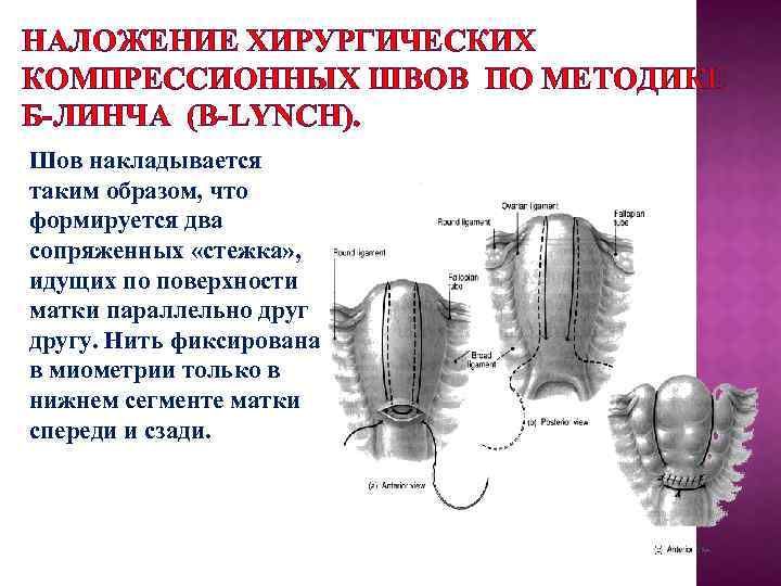 НАЛОЖЕНИЕ ХИРУРГИЧЕСКИХ КОМПРЕССИОННЫХ ШВОВ ПО МЕТОДИКЕ Б-ЛИНЧА (B-LYNCH). Шов накладывается таким образом, что формируется